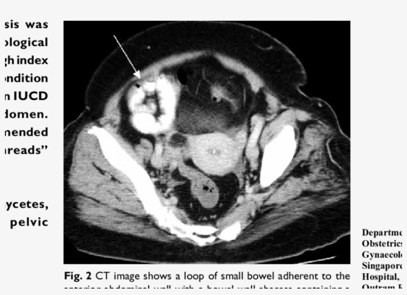 Ct Image Shows Inflammatory Stranding Of Fat And A - Pelvic Ct That Shows An Ovarian Mass, transparent png #5231742