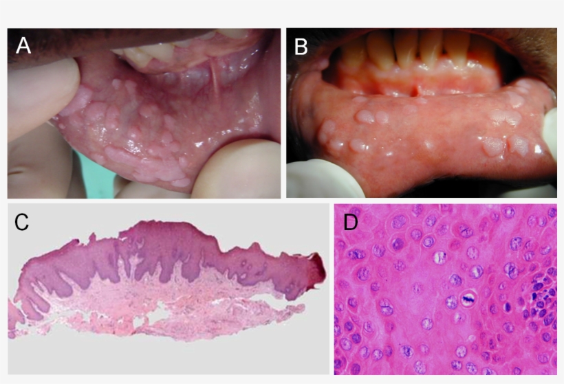 Figure 4 - - Difference Squamous Cell Papilloma Condyloma, transparent png #5391734