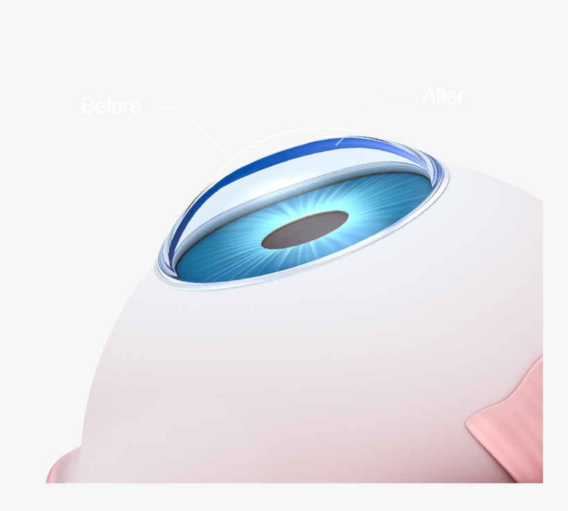 Conductive Keratoplasty, transparent png #5398200