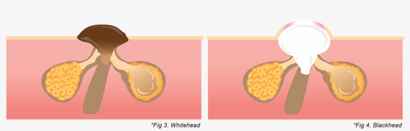 Acne Scars Graphic - Illustration, transparent png #540751