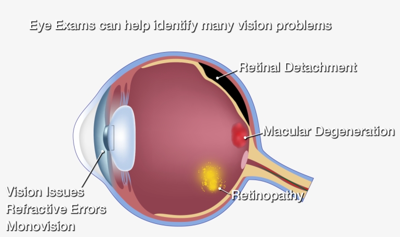 Side View Of Eyeball Side View Of Eyeball - Diagram Of Macular Degeneration, transparent png #5432072