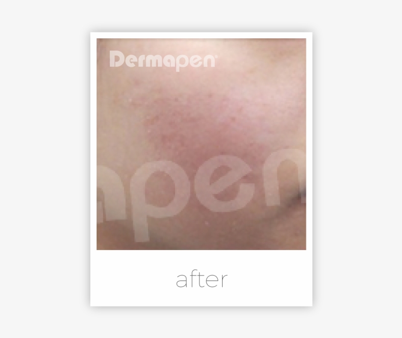 Dermapen Acne Scars - Dermapen Before After, transparent png #552891