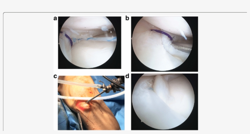 Intra Operative Images Showing The Final Repair - Television Show, transparent png #5595310