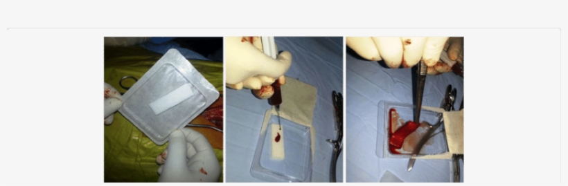 Surgical Gel Foam Saturated With Stem Cell Could Be - Stem Cell Research & Therapy, transparent png #562994