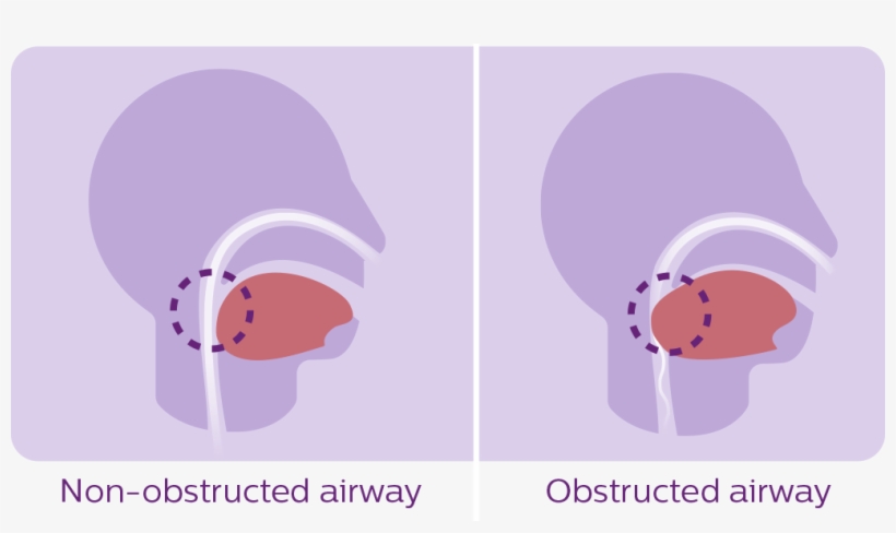 Sleep Apnea Diagram - Sleep Apnea, transparent png #5646643
