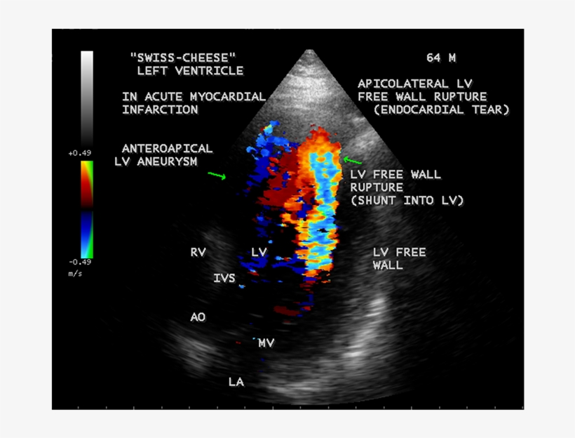 Apical 3 Chamber View Showing The Apicolateral Lv Free - Ventricular Free Wall Rupture Echo, transparent png #5670158
