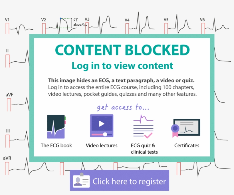 The Ecg Leads Includes The Limb Leads And The Chest - Cardiac Stress Test, transparent png #574342