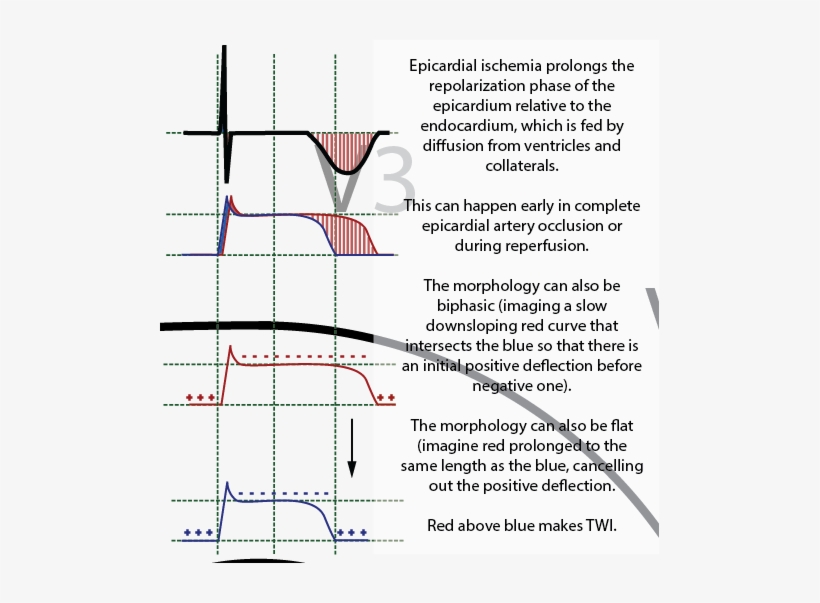 Spontaneous Reperfusion Or Decreasing Demand On The - Diagram, transparent png #575138
