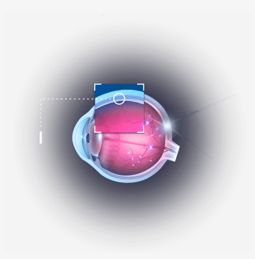 Eye - Suprachoroidal Cls Ta, transparent png #579443