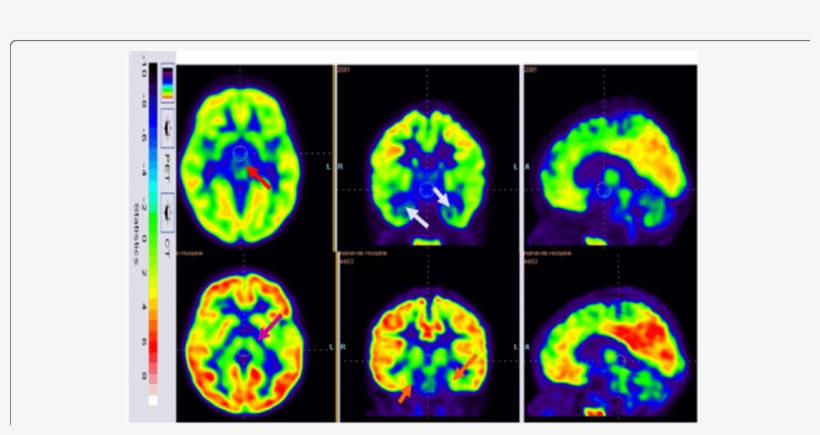 18 F-fdg Image Before Cellular Therapy Showing Reduced - Common Fig, transparent png #5731258