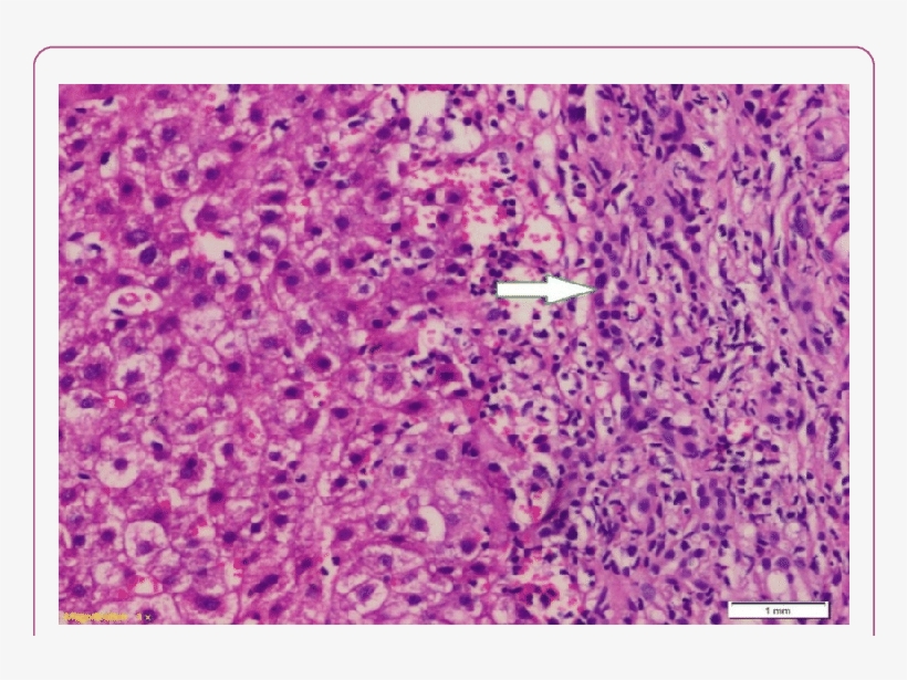High Power View Of The Previous Slide Showed Numerous - Fibrosis, transparent png #5731602