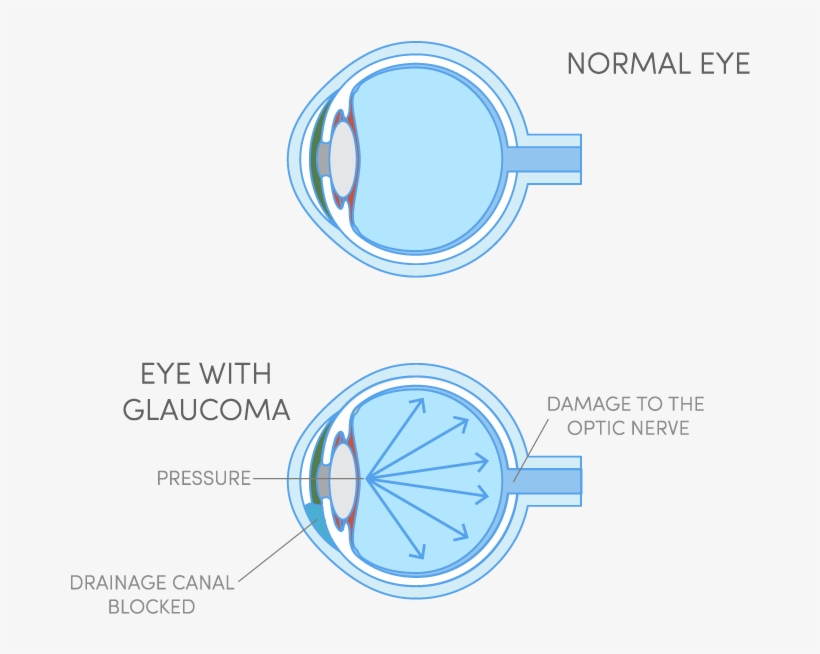 What Is Glaucoma - Circle, transparent png #5867737