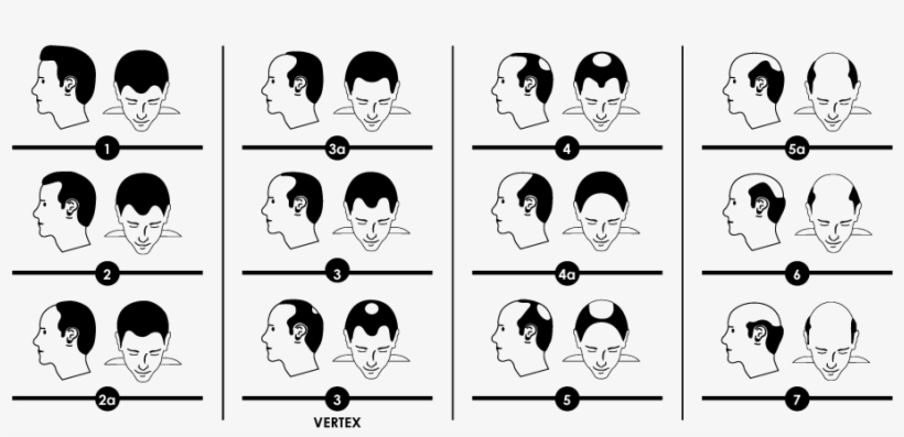 Norwood Scale For Male Hair Loss, transparent png #593226