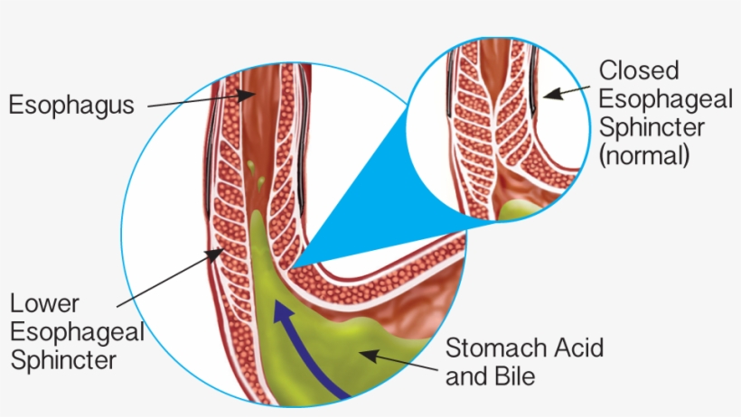Gerd Lower Esophageal Sphincter - Stomach, transparent png #5998673