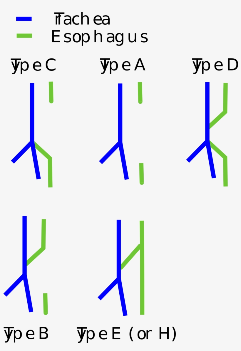 Tracheoesophageal Fistula Types, transparent png #5998781