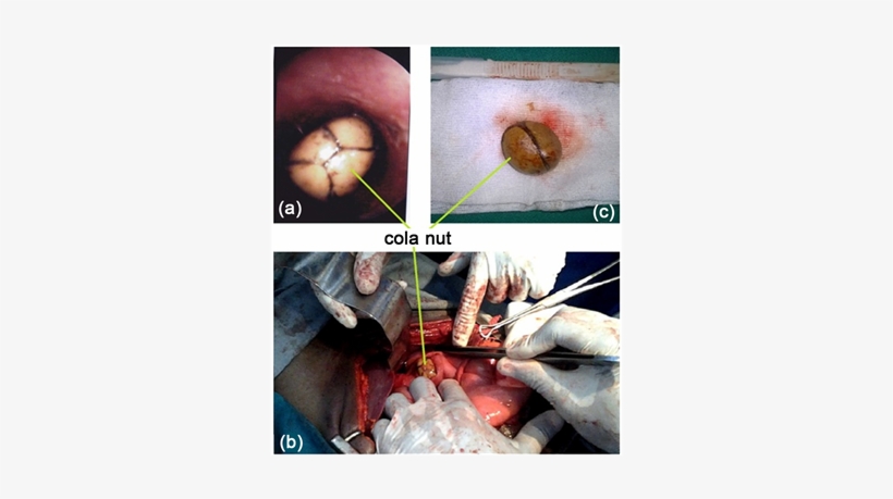 Endoscopic View Of The Cola Nut Blocked In The Esophagus - Esophagus, transparent png #5998933