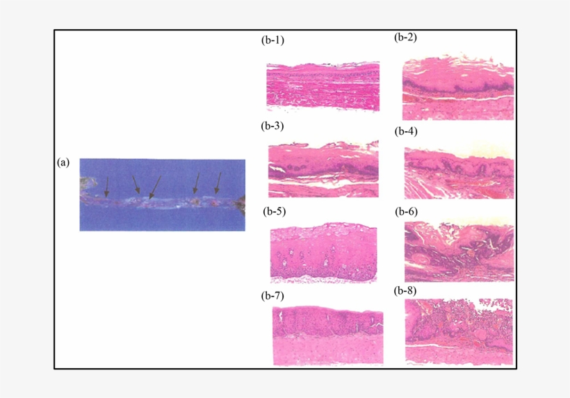 Various Pathological Lesions Induced By Nmba In A Rat - Dysplasia, transparent png #5999954