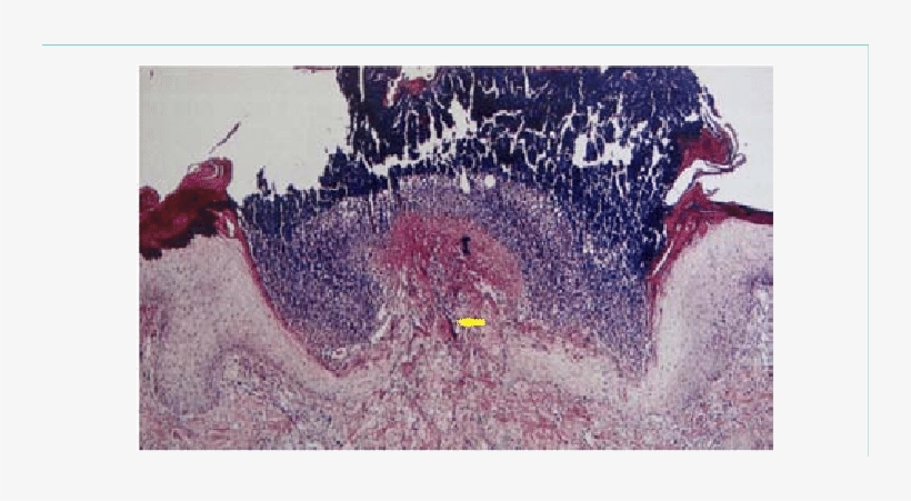 Histopathology Showing Prominent Epidermal Hyperplasia - Epidermis, transparent png #61338