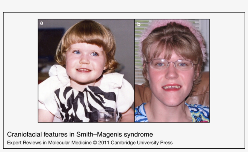 Download - Smith Magenis, transparent png #6006004