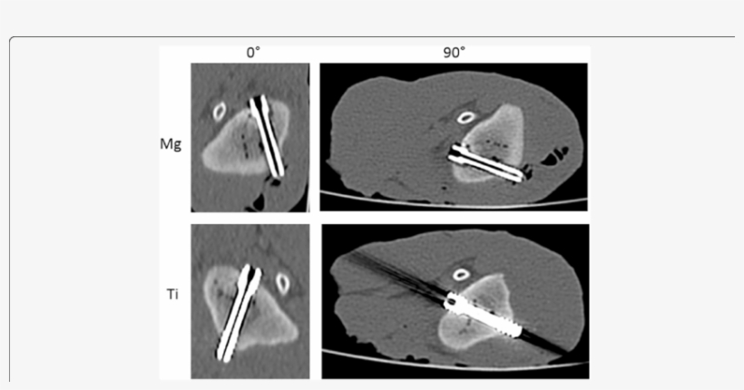Mg Screw And Ti Screw (bottom) In Mdct In - Common Fig, transparent png #6037923
