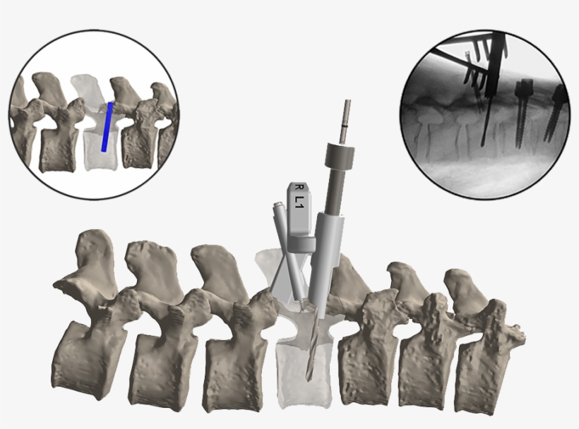 Firefly Pedicle Screw Navigation Guide, transparent png #6107878