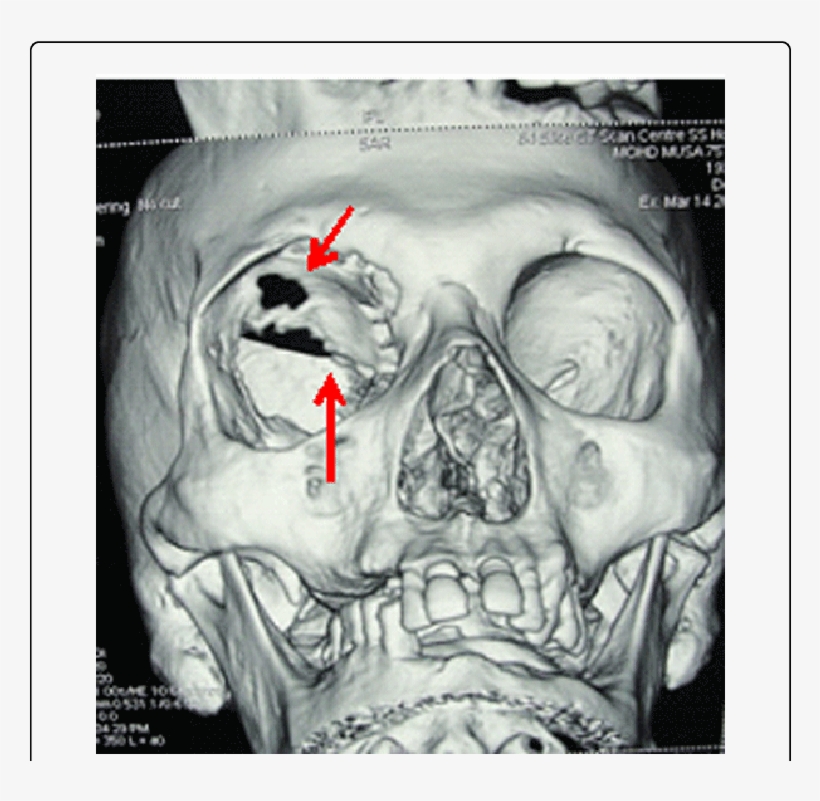 3 'd' Ct Image Showing Destruction Of Right - Sphenoid Bone, transparent png #6168317