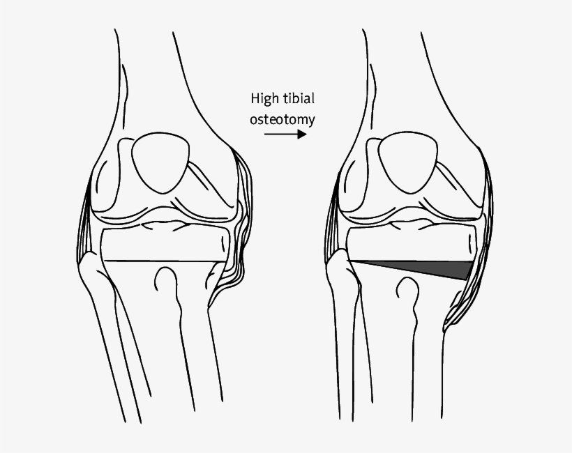 Example Of High Tibial Osteotomy Used For Varus Knee - High Tibial Osteotomy, transparent png #6271902