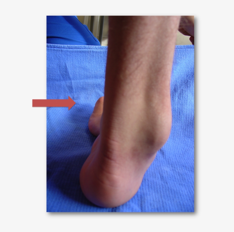 Charcot Marie Tooth Heel Varus - Thickened Nerves Charcot Marie Tooth, transparent png #6272678