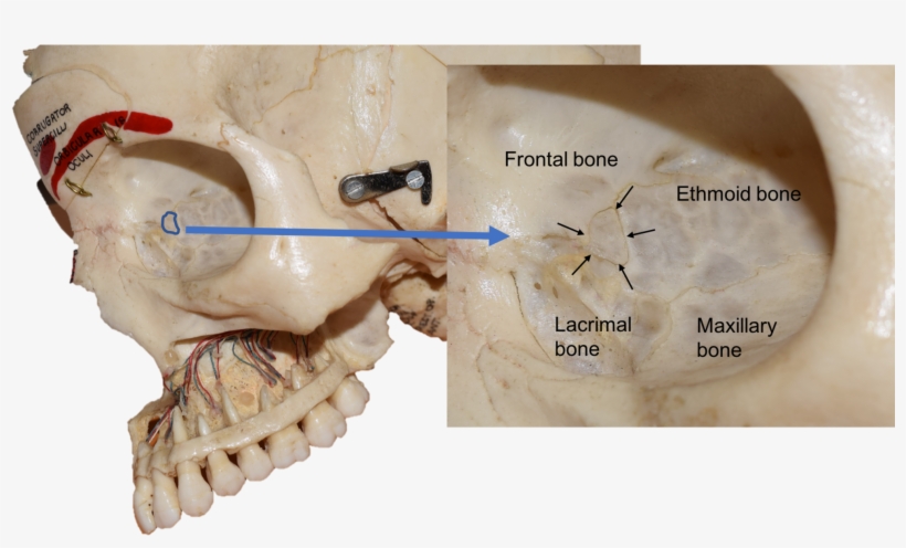 The Wormian Bone Is Outlined On The Left In Blue - Lacrimal And Ethmoid Bone, transparent png #6282531