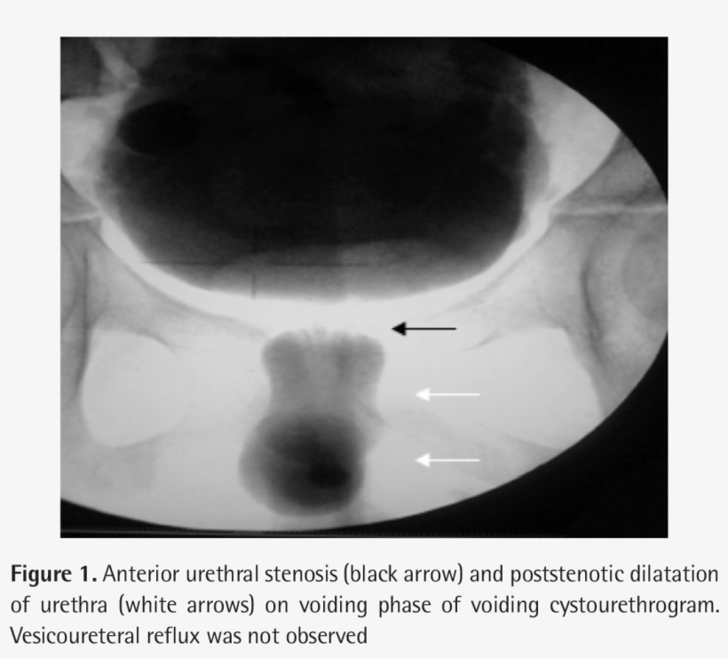 Cystourethroscopy Confirmed The Presence Of The Auv, transparent png #6356593