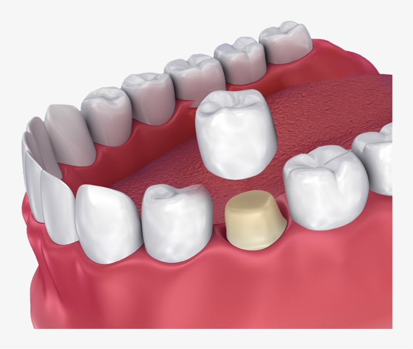 Dental Crown, transparent png #6377104