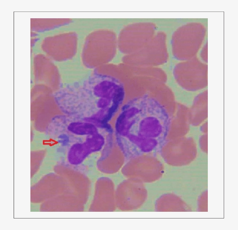 Peripheral Smear From Hospital Day Showing Rare Morula - Morula Inclusions, transparent png #6457017