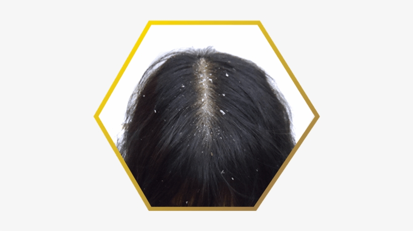 Dandruff Related Hair Loss- Jonsson Protein Singapore - Stop Sign Graffiti, transparent png #650117