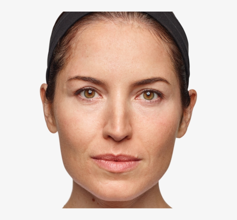 Woman Before And After Dysport Treatment - Dysport Injections, transparent png #651183