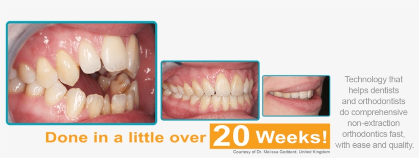 The Decision To Get Braces Can Be Scary One, transparent png #6500870