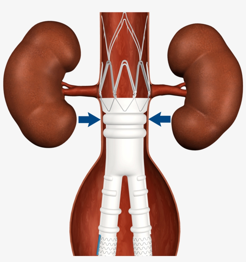 Stent Graft Comparison, transparent png #6663294