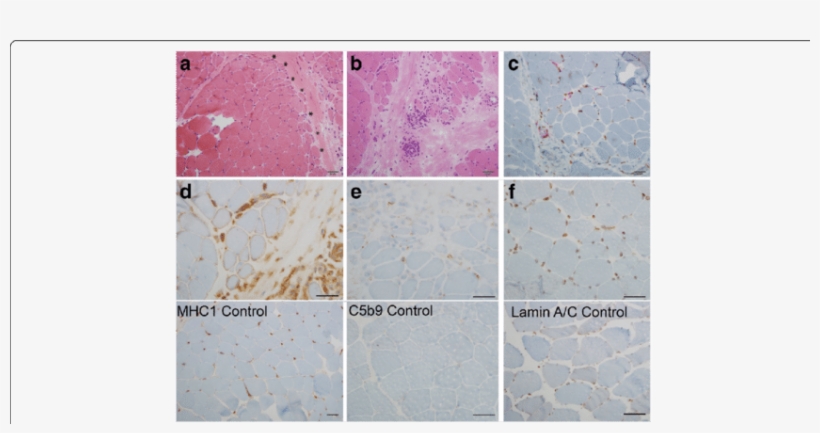 A Hematoxylin Eosin Staining Shows Prominent Perifascicular, transparent png #6670230