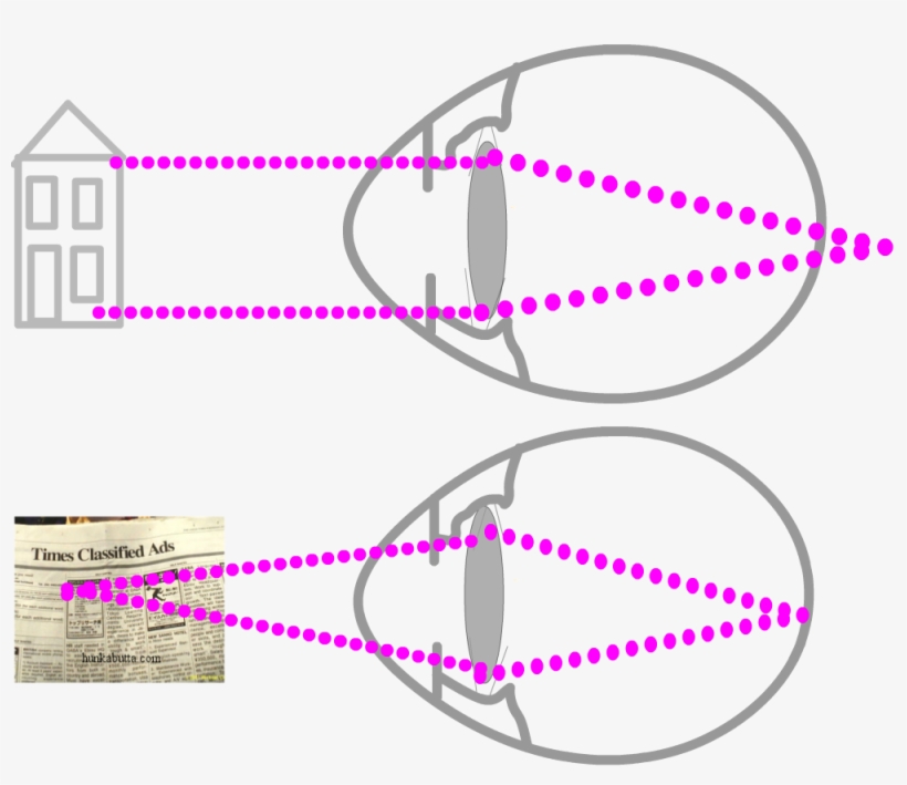 Opposite Of Myopia Medical Information And Advice, transparent png #6687940