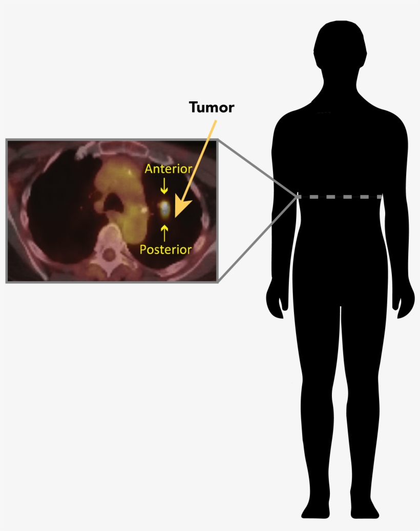 Positron Emission Tomography Can Be Used To Detect - Standing, transparent png #678143