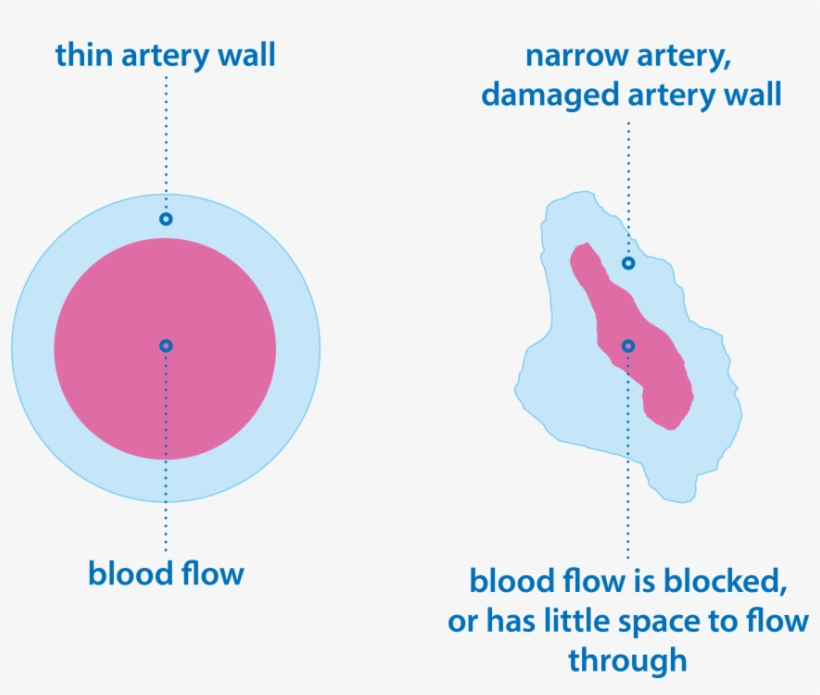Group 3 Pulmonary Hypertension Image Showing Narrow, transparent png #6734007