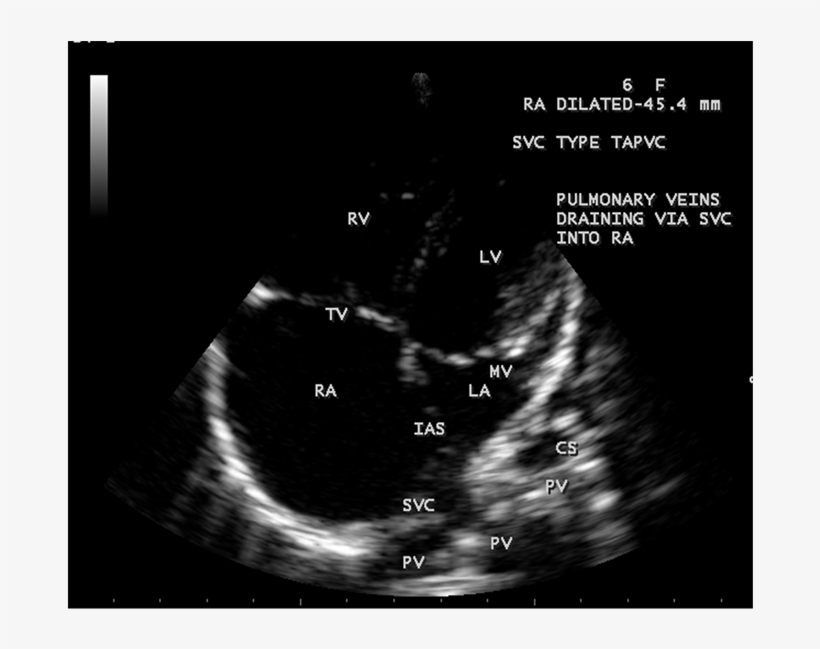 Svc Type Total Anamolous Pulmonary Venous Connection, transparent png #6844588
