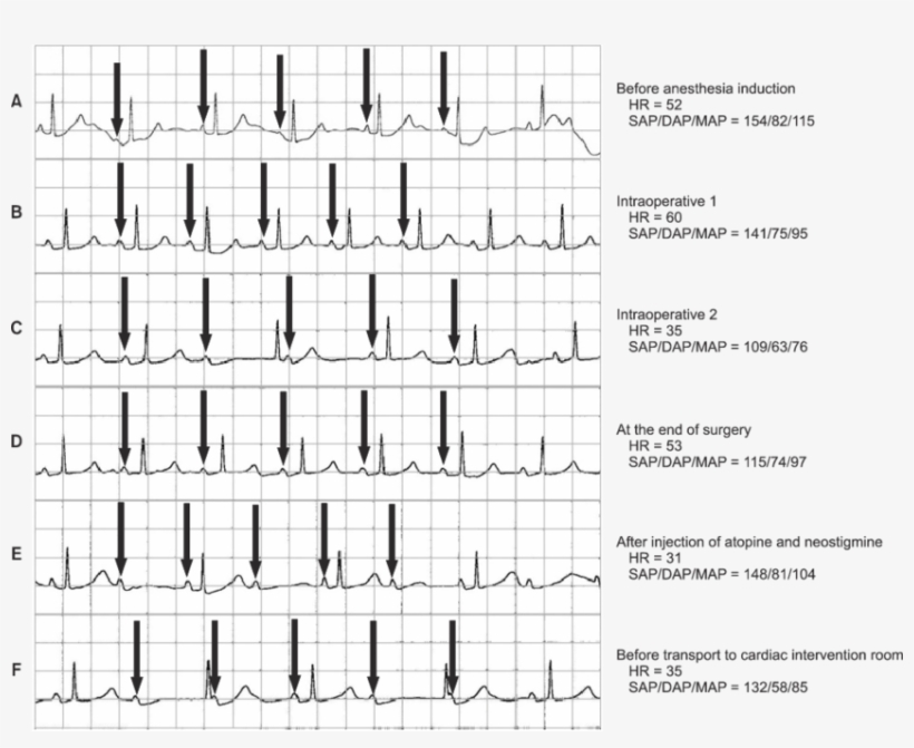 Electrocardiogram Waveforms And Vital Signs Were Retrieved, transparent png #6894861
