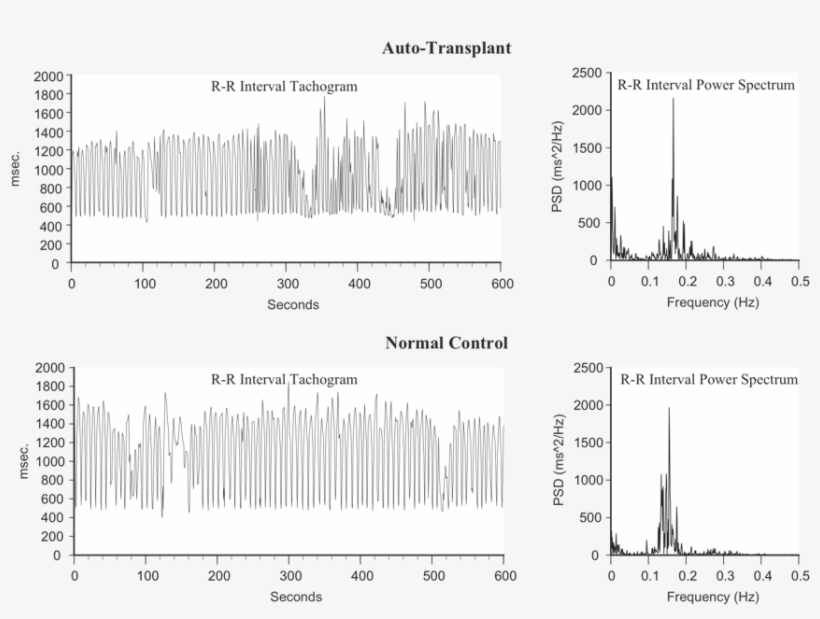 Heart Rhythms Generated By A Transplanted Heart At - Blood Pressure, transparent png #690653