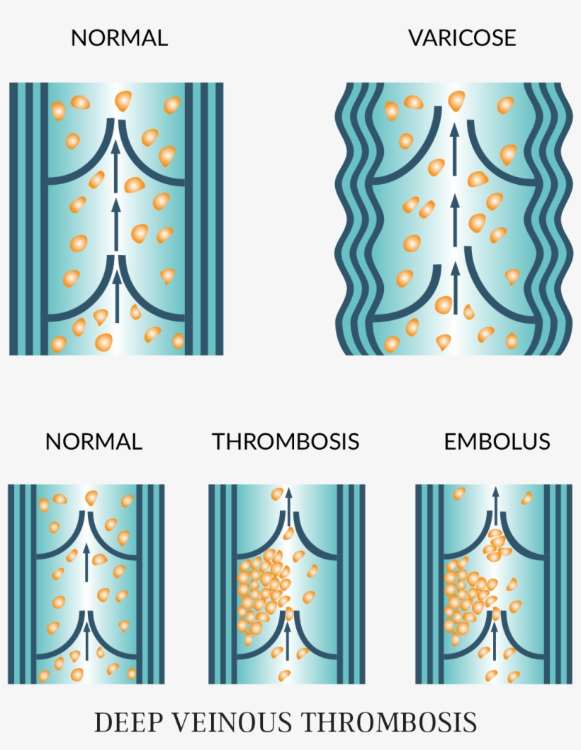 Varicose Veins - Graphic Design, transparent png #696843