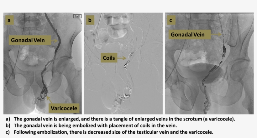 Varicocele Embolization Original - Varicocele Embolization, transparent png #696889