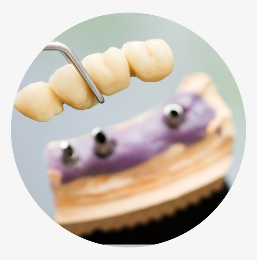 The Surrounding Teeth Deteriorate And It Is Just A, transparent png #6904052