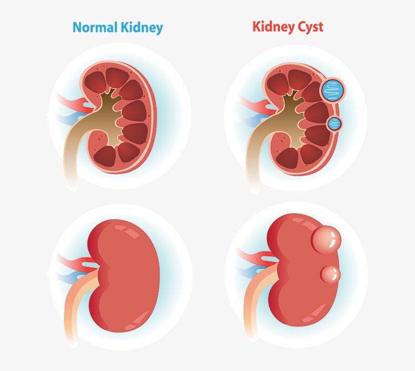 Are Kidney Cysts Rare, transparent png #6969298