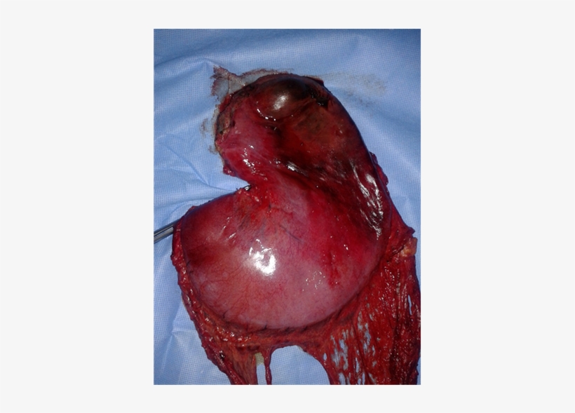 Specimen Of The Resected Stomach - Duck Meat, transparent png #709991