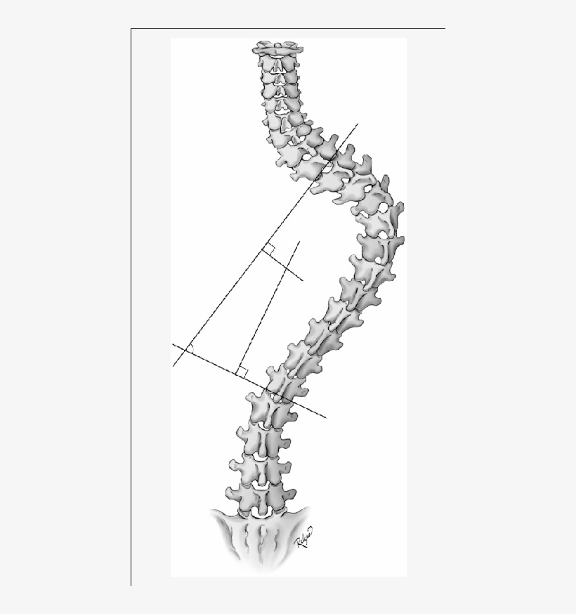 Measurement Of The Cobb Angle, transparent png #7008614