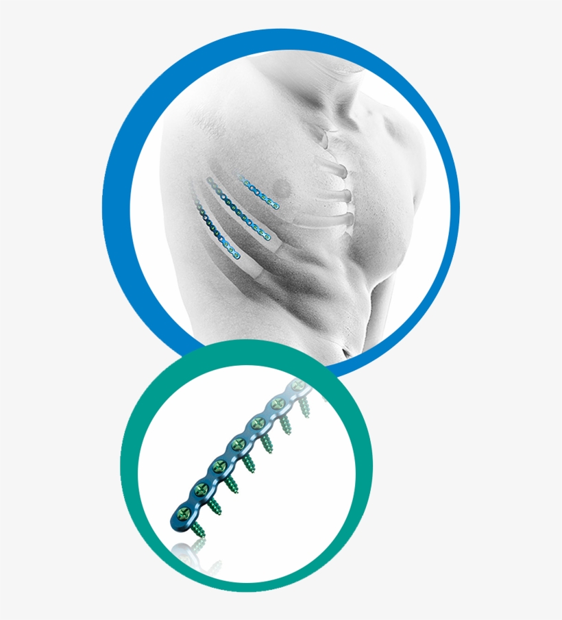 Rib Fixation, transparent png #7077408